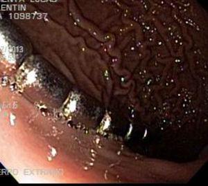 Endoscopic image of the magnets at the level of the greater curvature of the stomach.
