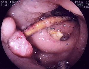 Endoscopic image of a foreign body (chicken bone) impacted in the diverticular orifice of the sigmoid colon, with an intense inflammatory reaction.