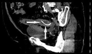 Abdominal computed tomography scan showing the foreign body (chicken bone) penetrating the wall of the sigmoid colon, with pelvic fascia thickening.