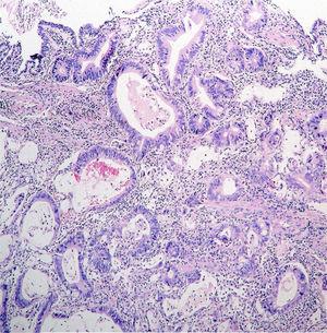 H&E stain; intestinal-type adenocarcinoma.