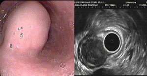 Endoscopic and ultrasound visualization of the 21 x 25mm esophageal lesion.