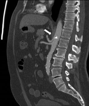 Sagittal CT image. The median arcuate ligament (white arrow) is located anterior to the celiac trunk. The characteristic stricture can be seen proximal to the celiac trunk (arrowhead).