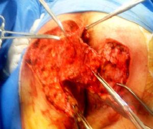 Surgical treatment with ample resection, debridement, and bilateral gluteal, perianal, and scrotal fistulotomies.