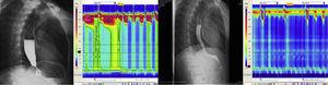 The esophagogastroduodenal series and anorectal manometry carried out before and after the procedure.