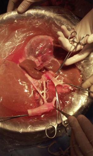 Dissected portal vein.