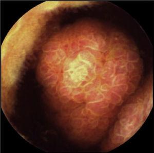 Capsule endoscopy image showing the large ulcerated polyp occupying part of the intestinal lumen.