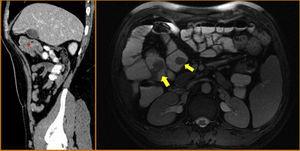 On the left, the sagittal CT image shows various polypoid formations that are acting as the head of the intussusception of a jejunal segment (asterisk). On the right, the axial magnetic resonance enterographic image identifies several polypoid lesions in the jejunum and proximal ileum (yellow arrows).