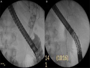 A) Initial cholangiogram: a 20mm square-shaped stone impacted in the middle bile duct, and multiple stones on top of it. B) Placement of the completely covered self-expandable metal biliary stent.