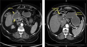 Abdominal CT scan showing impacted lithiasis at the pyloroduodenal level and the gastric obstruction.