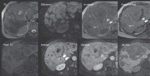 Metastasis. A 61-year-old woman with a history of cancer of the left breast. Follow-up ultrasound identified multiple dispersed focal lesions in the hepatic parenchyma. MR was done to improve characterization. Top row: The presence of multiple rounded images of diffuse distribution, hypointense on T1 and hyperintense on T2 and diffusion (DWI), with no signal decay in the out-of-phase sequence. Bottom row: In the dynamic sequences with gadoxetic acid, said lesions present with ring enhancement on the arterial phase and centripetal fill-in on the later phases. The lesions are observed to be hypointense on the hepatobiliary phase due to the absence of hepatocytes. In addition, other lesions are identified that have similar characteristics and enhancement of the vertebral bodies and paravertebral muscles. Data are related to metastasis.