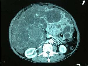Multiple hepatic cysts, one of which was hemorrhagic.