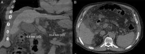 A) Abdominal tomography scan showing: free fluid, small liver, vena porta with a 19.4mm diameter, and no thrombi. B) A normal pancreas and no retroperitoneal adenomegalies.