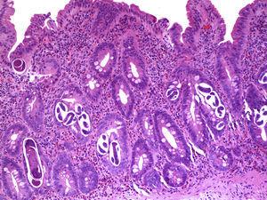 Duodenal mucosa with mild atrophy. The crypts show numerous rhabditiform larvae of Strongyloides stercoralis. The lamina propria shows an intense eosinophilic-rich acute and chronic inflammatory infiltrate (H&E, x100).