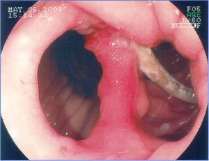 Large gastrogastric fistula with partial band migration after gastric bypass surgery.