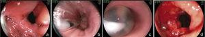 Band dilation after gastric bypass surgery. a) Band stricture. b) and c) Progressive balloon dilation of 30mm. d) Final aspect after dilation.