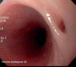 Endoscopic image of the tracheoesophageal fistula prior to treatment.