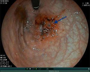 Application of argon plasma electrocoagulation in vascular ectases in the gastric fundus (arrow).