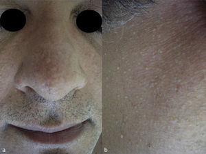 Clinical image showing multiple, smooth, firm, cupuliform normal skin-colored papules on the nasal dorsum (a) and on the right cheek (b), indicative of fibrofolliculomas.