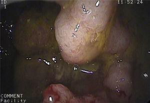 Endoscopic image showing an ulcerated sessile polyp located in the cecum.