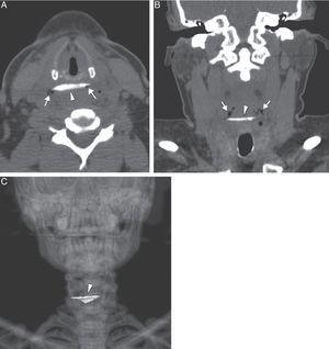 A) Axial and B) coronal computed tomography images showing the bone-like foreign body (arrowhead) at the level of the proximal esophagus, with small air bubbles in the soft tissue (arrows) as a sign of limited perforation. C) Coronal computed tomography volume-rendered 3D reconstruction image of the bone-like foreign body (arrowhead).