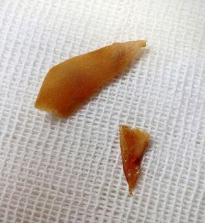 The extracted sharp-edged chicken bone (foreign body) broken into 2 pieces for its removal.