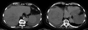 Abdominal computed axial tomography scan: subcapsular hematoma and hemoperitoneum.