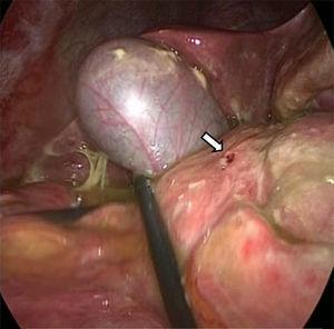 A 5mm perforated duodenal ulcer on the anterior surface of the first part of the duodenum (white arrow).