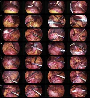 A) Exposure with retraction of the round ligament with a Penrose drain. B) Dissection by way of the gastrocolic ligament to approach the lesser sac. C) Identification of the pancreatic duct with laparoscopic ultrasound and the opening of the duct. D) Roux-en-Y formation. E) Placement of the isoperistaltic Roux loop. F) Enterotomy and formation of the pancreaticojejunal anastomosis. G) Completion of the pancreaticojejunal anastomosis and placement of the closed drain.