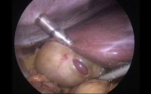 Gallbladder with multiple omental adhesions, pericholecystic fluid, and a 1 x 0.5 x 0.5cm mass with the appearance of liver tissue in the medial gallbladder wall.