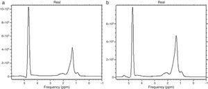 Spectroscopy of lipids. Graphs a and b show 2 main peaks: on the left, an elevated peak that corresponds to water and on the right, a lower peak that corresponds to triglyceride concentration. Note that the triglyceride peak is higher in image b in a patient with a greater lipid concentration.