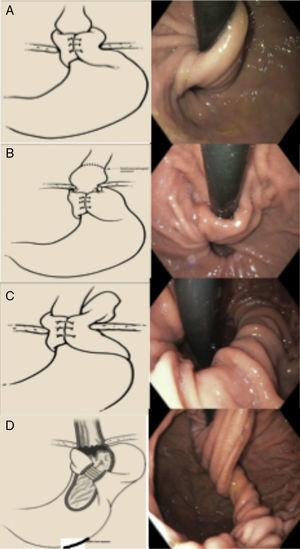 Types of failed fundoplication (Horgan classification). A) Type IA: hernia with no fundoplication herniation. B) Type IB: with fundoplication herniation. C) With paraesophageal displacement. D) Defect in the formation of the fundoplication. Taken from Horgan and Pellegrini.30