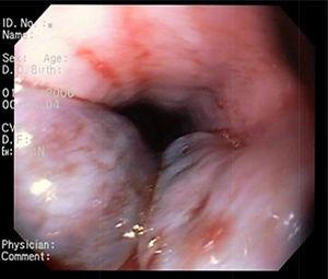 Venous dilations in the proximal third of the esophagus, with no evidence of active bleeding.
