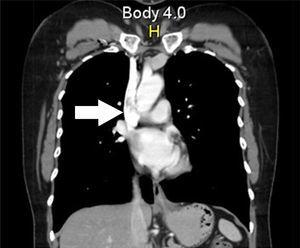 Chest CT showing the thrombus in the superior vena cava.