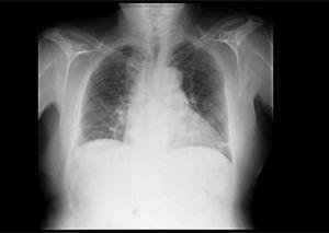 Posteroanterior chest x-ray with atelectasis in the lower left lobe of the lung.