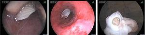 Endoscopic diagnosis: extraction of the foreign body (Venus clam shell) in the mid-esophagus. Hiatal hernia.