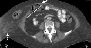 Axial view of abdominal tomography scan showing the Spigelian hernia (white line), previous mesh (white arrow), and heterogeneous fat of the wall (white dotted arrow).