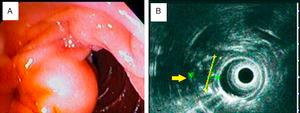 Ampullary lesion images. A) Duodenoscopy showing the subepithelial lesion. B) Endoscopic ultrasound view of the 21.0 x 16.9mm, hypoechoic, heterogeneous lesion completely covered by mucosa and not affecting the muscular layer of the duodenum (yellow arrow).