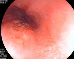 An ulcer measuring approximately 2cm, with raised edges covered with a scant quantity of fibrin, and another smaller mirror-image ulcer are shown.