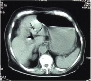 Non-contrast abdominal CT scan showing pneumobilia.