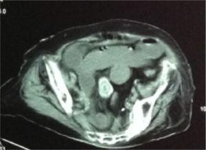 Obstruction and impaction of the gallstone site.