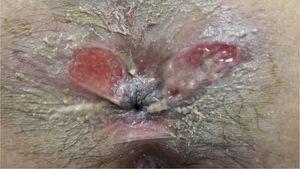 Atypical location of perianal ulcers of the patient.