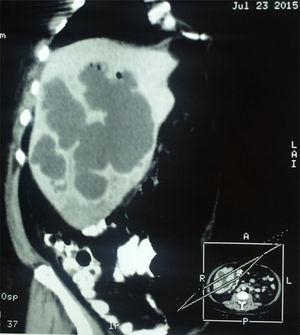 Oblique sagittal view of a double-contrast computed tomography scan showing cystic lesions, corresponding to amoebic liver abscesses.