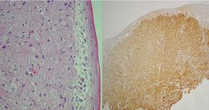 On the left, hematoxylin and eosin stain show abundant eosinophilic granules. On the right, immunohistochemistry shows S-100 protein expression.