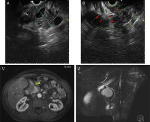 A and B) Endoscopic ultrasound defined a largely hypoechoic lesion, with some anechoic areas and poorly defined limits. Color Doppler ultrasound was negative for vascular flow. C and D) The magnetic resonance imaging scan shows a spontaneous hyperintense lesion on T1 and T2 in the proximity of the gastroduodenal artery, with no enhancement after gadolinium administration. No communication with the common bile duct or pancreatic duct was observed.