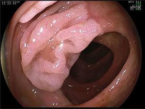 Chromoendoscopy with the application of acetic acid facilitates the characterization of the lesion and the delineation of its boundaries.