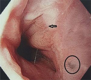 Gastroesophageal junction with single melanocytic lesion with irregular edges.
