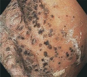Body of the gastric mucosa with multiple melanocytic lesions of different sizes.