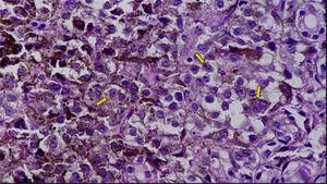 Large neoplastic cells with atypical nuclei with macro-nucleolus and abundant clear or eosinophilic cytoplasm with cytoplasmic melanin.