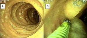 A) Normal duodenal mucosa is observed. B) Jejunal mucosa tattooed with organic carbon dye.