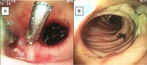 A) Diverticulum of the ileum with an adhered coagulate and visible vessel with 2 hemoclips. B) Benign ulcer in the ileum.